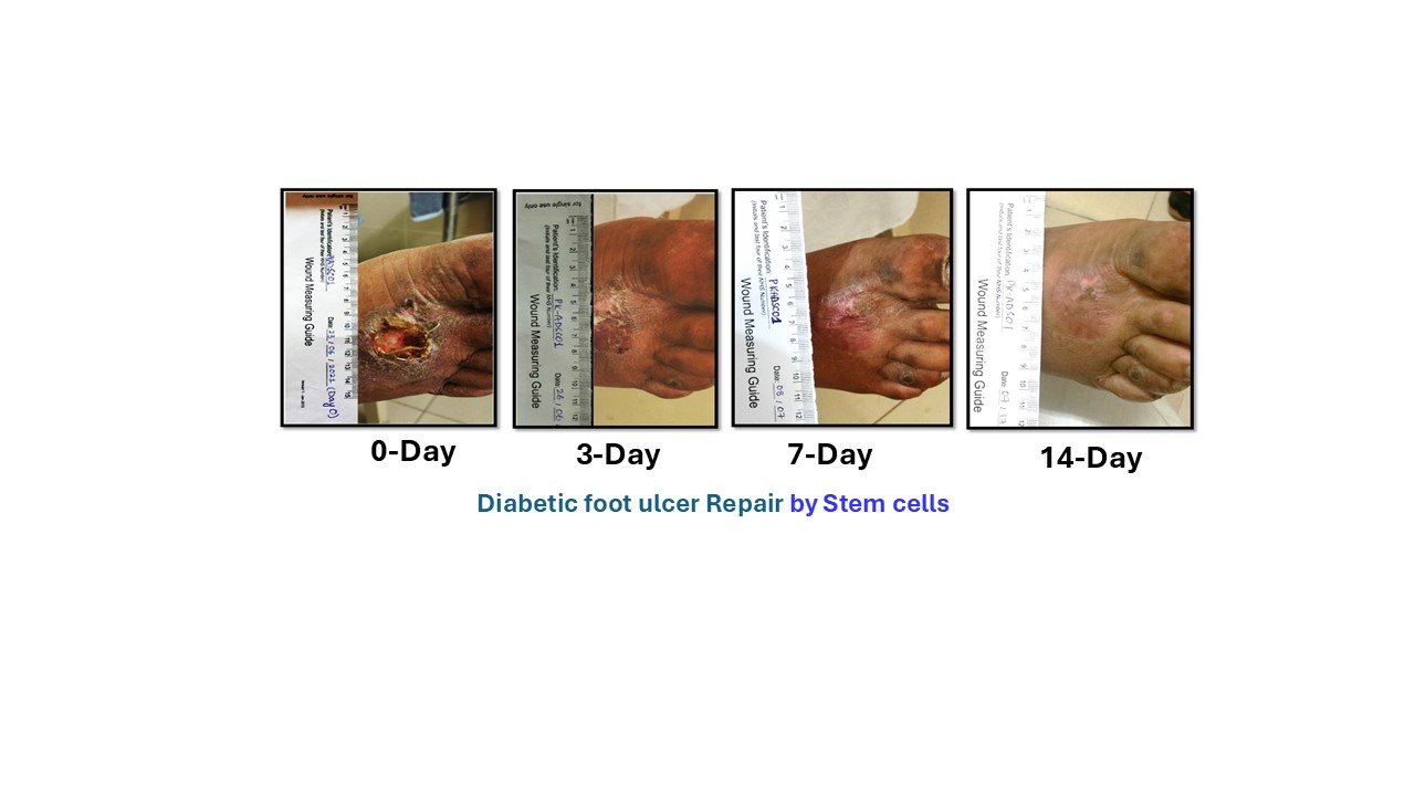 Biomedical artwork representing stem-cell-supported diabetic wound repair